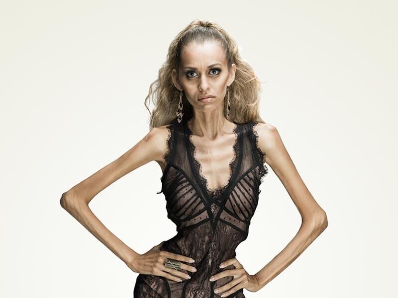 ANOREXIQUE